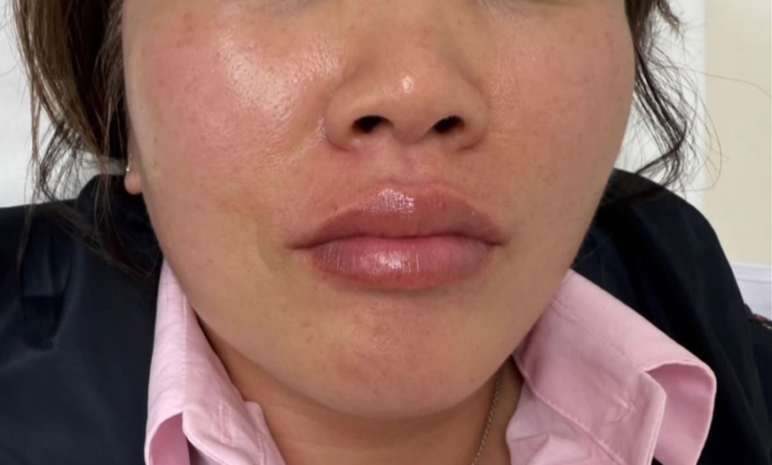 Image 5: 1 or 1.5 Syringe Restylane Kysse Lip Filler + Optional 20U Xeomin
