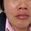 Image 5: 1 or 1.5 Syringe Restylane Kysse Lip Filler + Optional 20U Xeomin