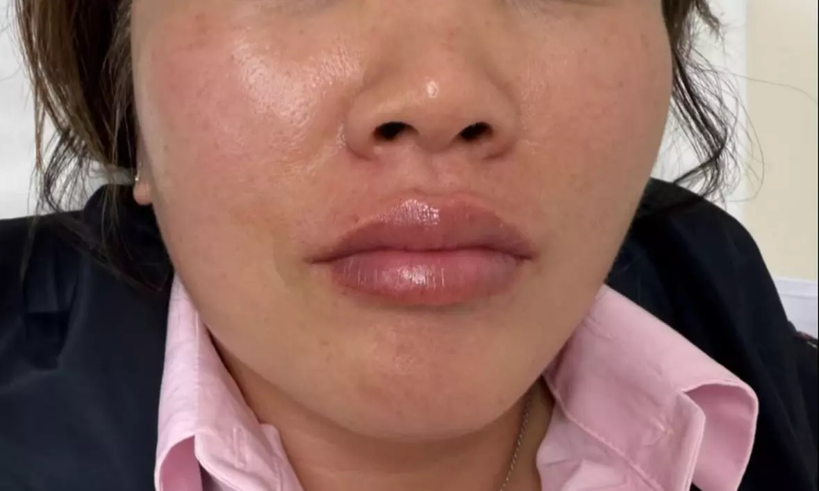1 or 1.5 Syringe Restylane Kysse Lip Filler + Optional 20U Xeomin