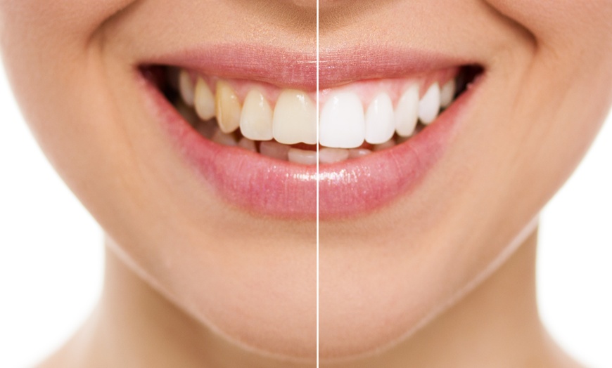 Image 5: Experience Dazzling Results with In-Office Zoom Teeth Whitening!