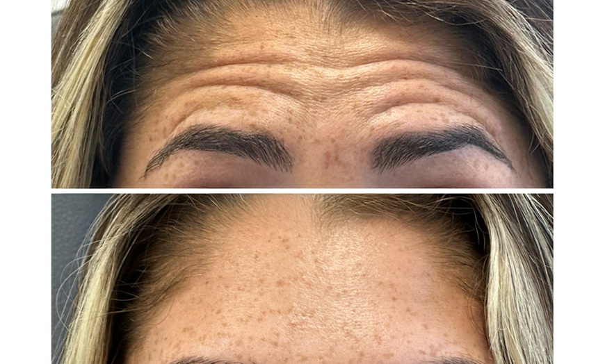 Image 3: First or ToxBooster 20 Units of Botox with Optional VI Peel