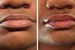 Half (0.55mL) or Full Syringe  (1mL) Lip Filler-Limited Time Deposit at Suite Novella Aesthetics (Up to 78% Off) - Second Medium