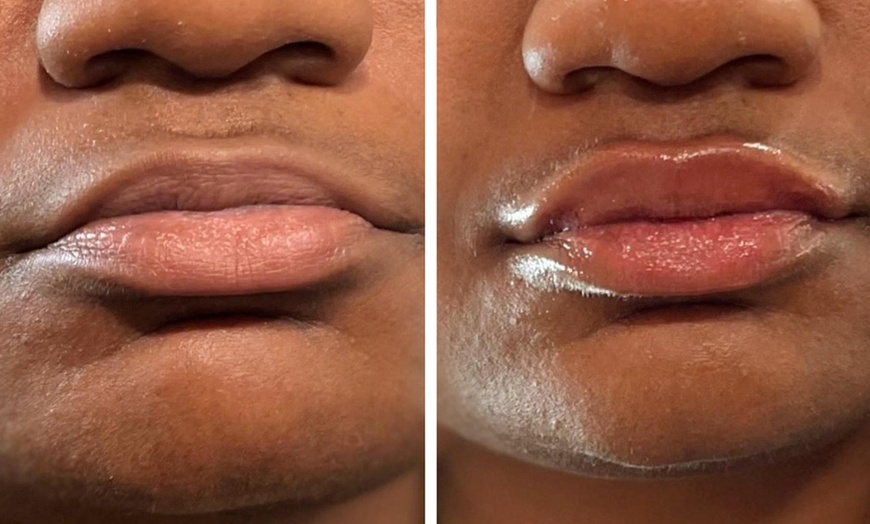 Image 2: Half (0.55mL) or Full Syringe  (1mL) Lip Filler - Limited Time Deposit