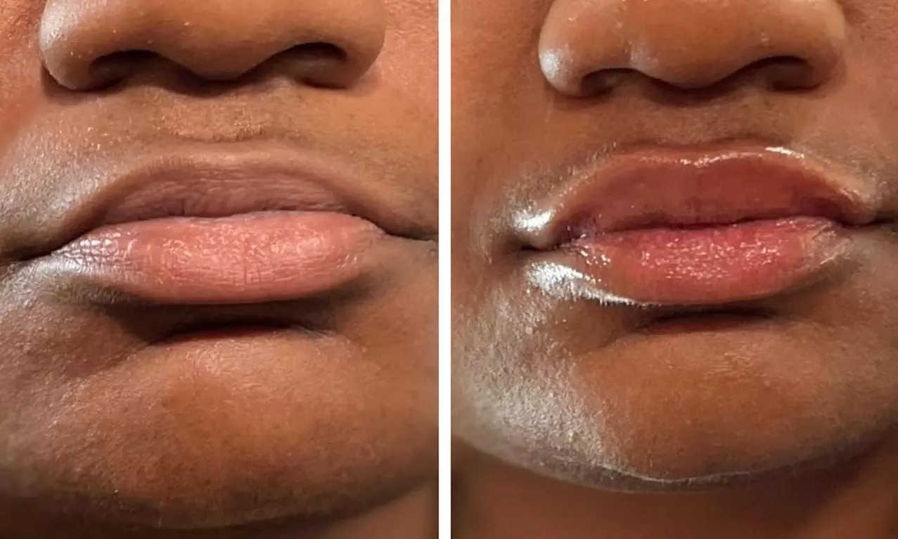 Half (0.55mL) or Full Syringe  (1mL) Lip Filler - Limited Time Deposit