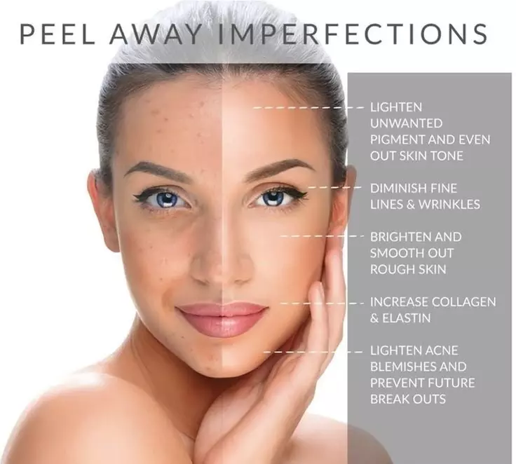 Experience Bev And Vicky Beauty Bar's chemical peel with aftercare for a refreshed look, all while saving up to 55% - Primary Image