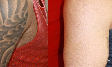 Three Laser Tattoo Removal Sessions on a Small Area - Dr. Rick A. Carpenter