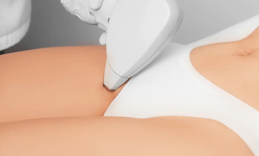 Image 3: 3 Laser-Haarentfernungen an einer kleinen oder mittleren/großen Zone