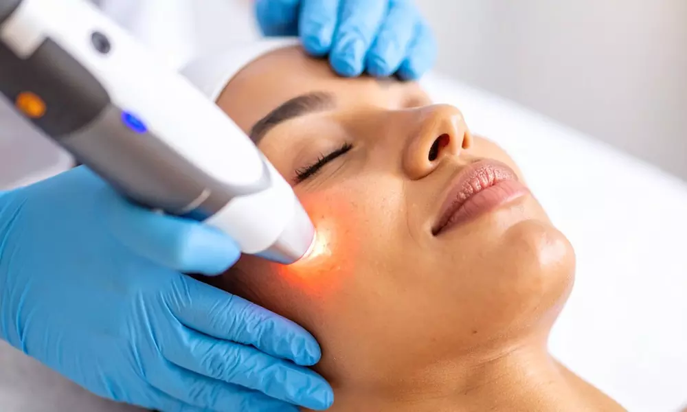 Clear Acne w/ Cutting-Edge Single/Double Laser Acne Treatment at A Bless Beauty (Up to 69% Off) - Primary Image