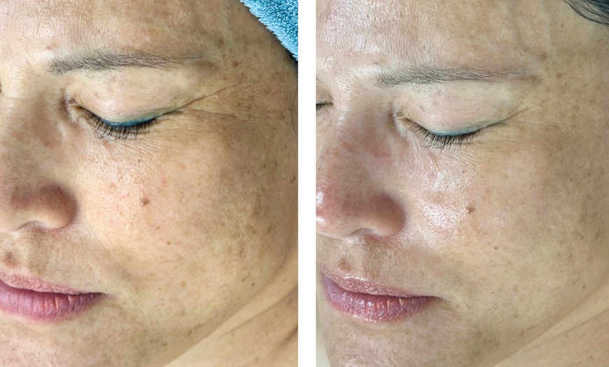 Image 9: Up to 55% Off on Facial - Chosen by Customer at Rise Skin Spa
