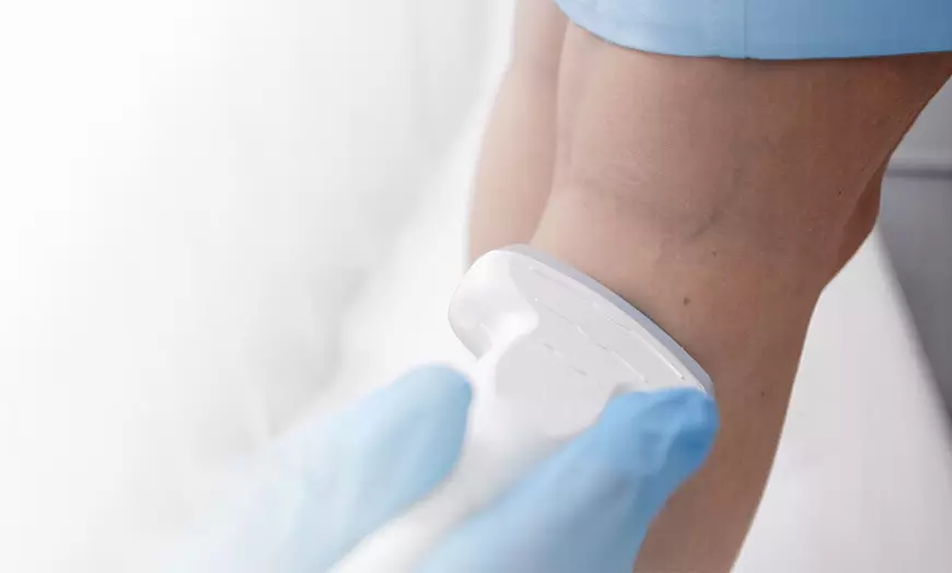 Image 14: Eliminación de varices o verrugas con tecnología avanzada 