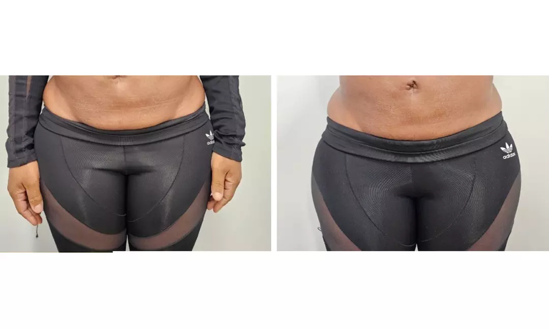 Enjoy Pressotherapy Lymphatic Massage, RF Tightening, or Cavitation!