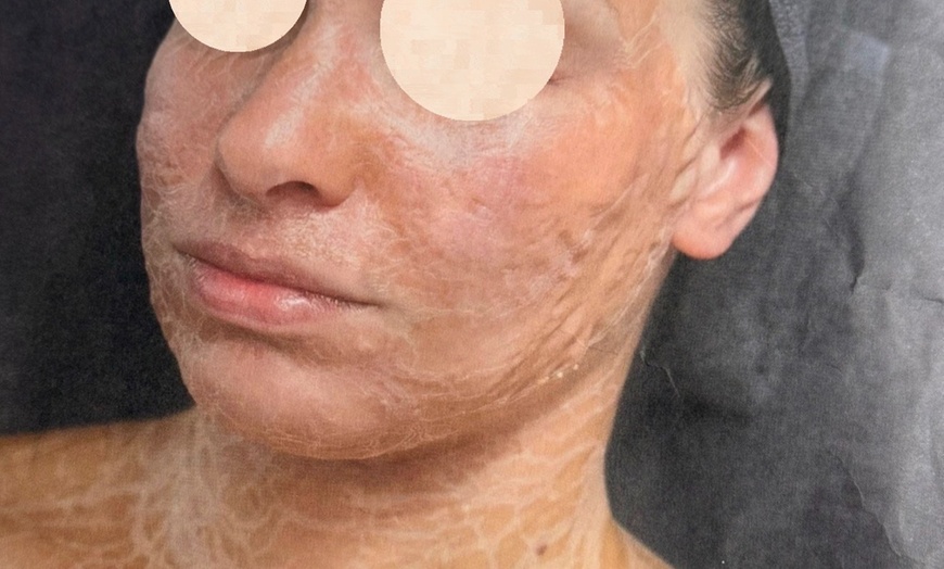 Image 2: 1, 2 of 4 Biopulse therapie gezichtsbehandelingen van 75 minuten