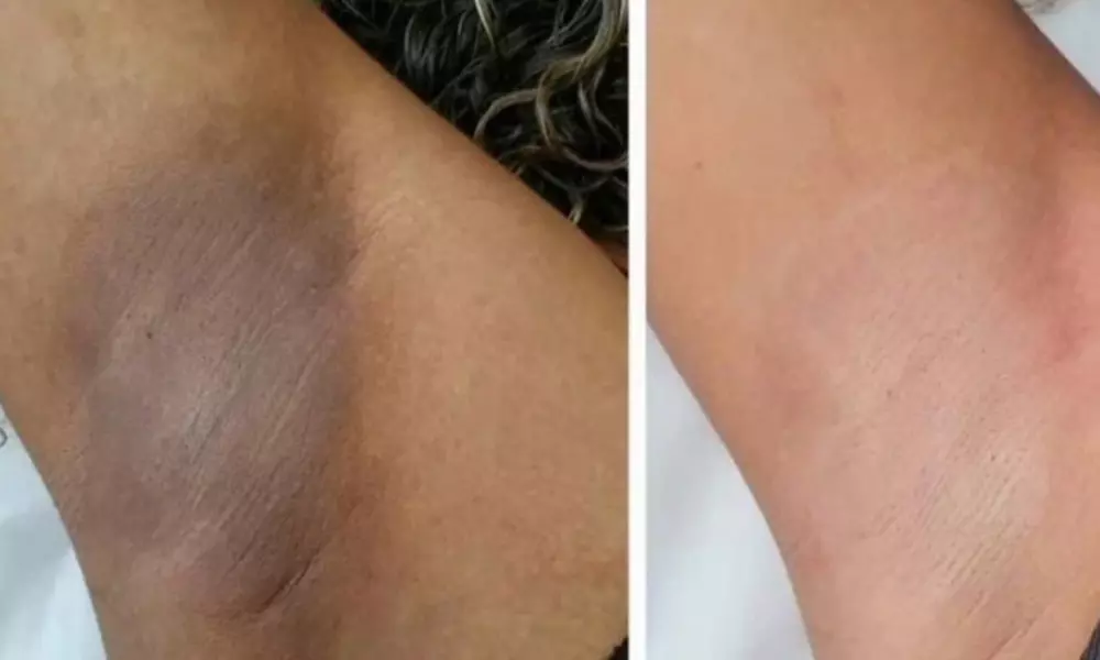 Targeted Skin Whitening Sessions for Underarms and Intimate Area