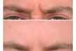 Transform Your Look with 30 or 60 Units of Dysport at Youthful Glow ( Up to 51% Off ) - Second Medium