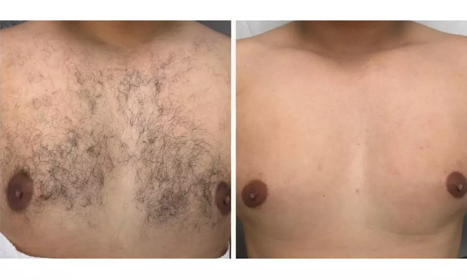 Up to 83% Off on Laser Hair Removal at HL Lasers