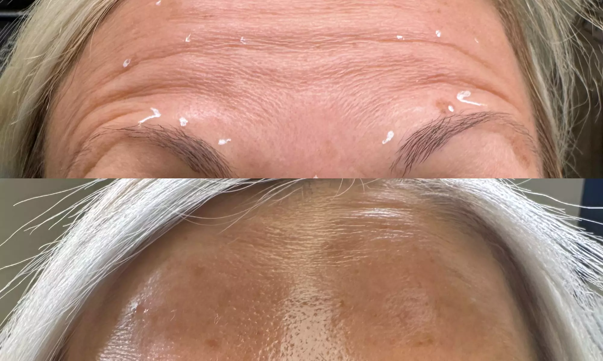 Get a Youthful Glow with 20, 40, or 60 Units of Daxxify