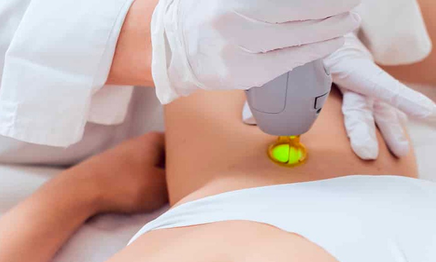 Image 1: 5 séances d'épilation laser de zone(s) au choix à Nancy