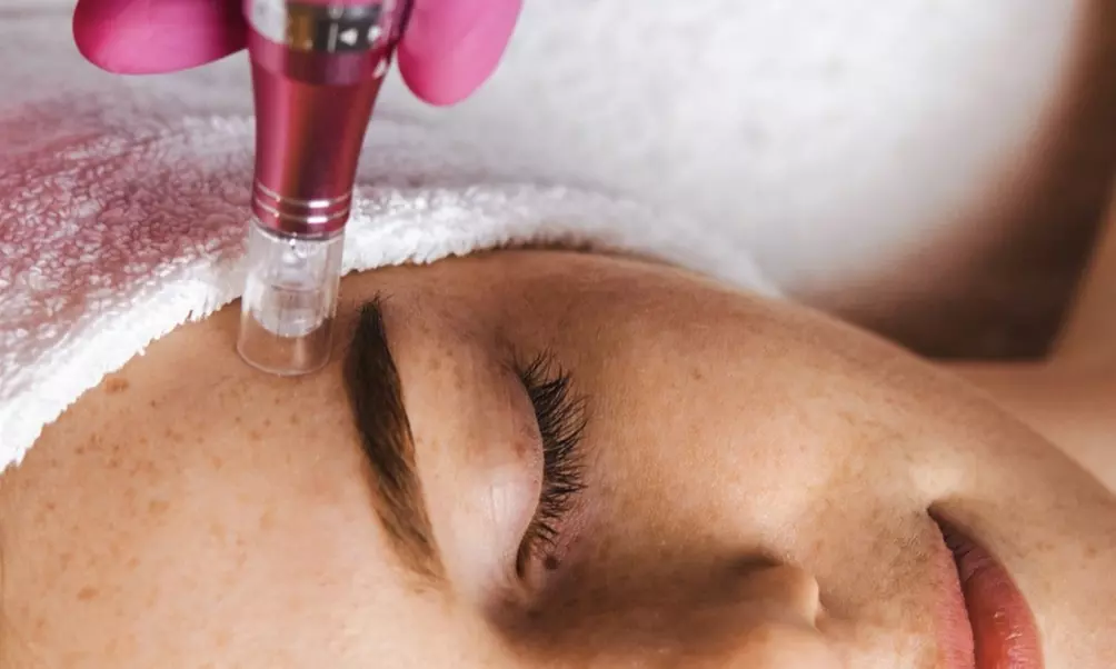 Get One, or Three PRP Facials, Vampire Face Tightening & Microneedling