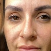 Image 1: 1 o 2 sesiones de fibroblast con plasma pen facial completo para 1