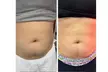 Smoother Contours with One or Two Non Invasive Laser iLipo + Cavitation & Wood Therapy @Bare Skin (Up to 87%Off) - Second Medium