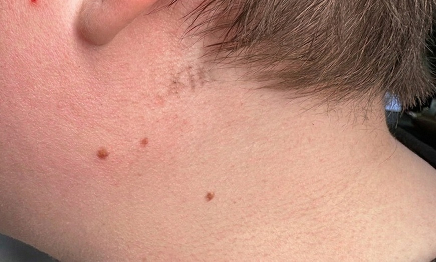 Image 3: 3 Laser Tattoo Removal Sessions: Small, Medium, Large or XL Areas