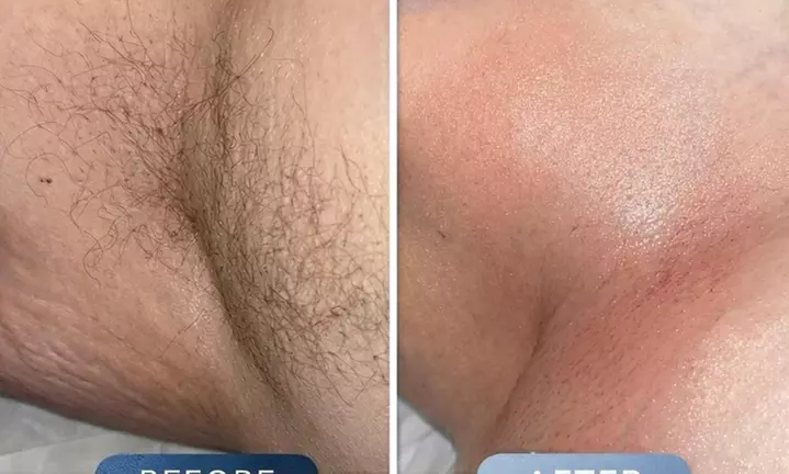 Brazilian Wax with Inner Thigh Lower Legs Stomach Strip or Underarms