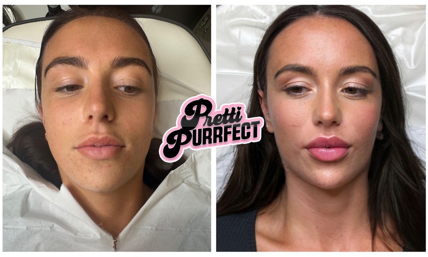 Image 7: One or Two Profhilo® Skin Revitalising Booster Sessions