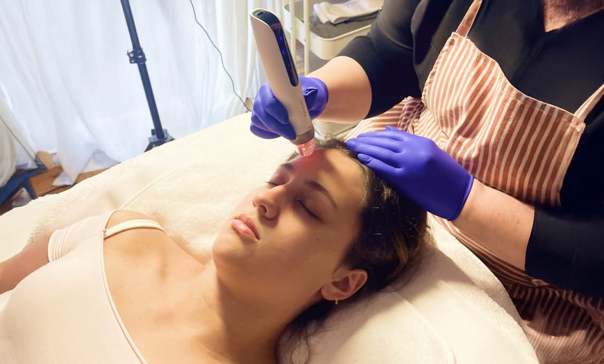 Image 1: One, Two, Three or Four Sessions of Full Face Micro-Needling