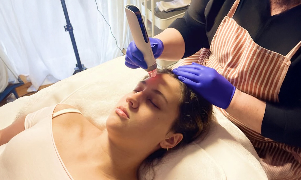 One, Two, Three or Four Sessions of Full Face Micro-Needling