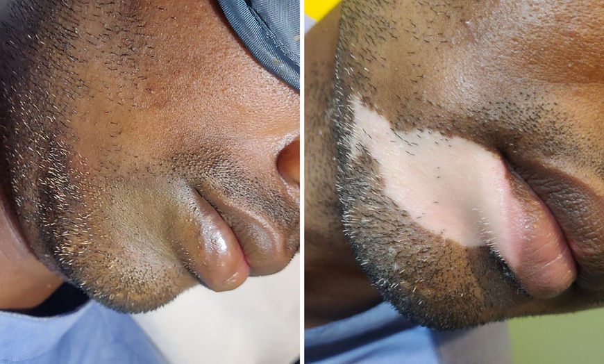 Image 2: Transform Your Skin with Vitiligo or Stretch Marks Camouflage Services
