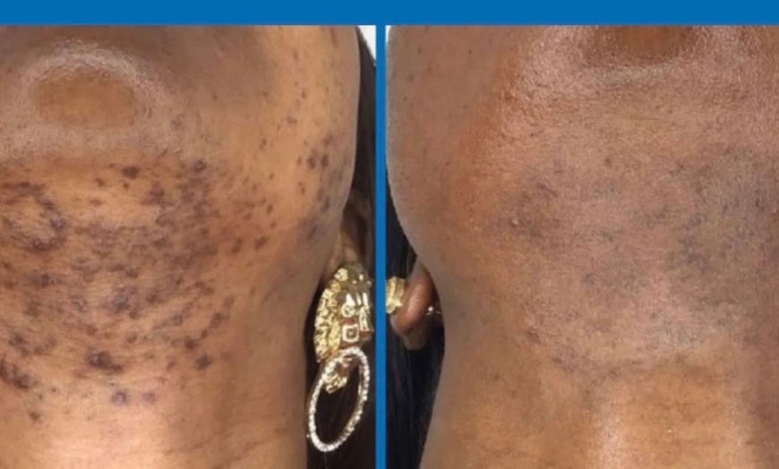 Image 2: Enjoy Smooth Skin with Six or Three Sessions of Laser Hair Removal