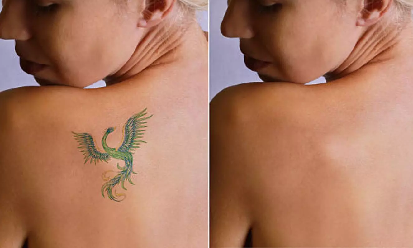 5 o 10 sesiones de eliminación de tatuajes