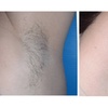Image 3: 6 Sessions of Laser Hair Removal in Small, Medium, Large Areas & More