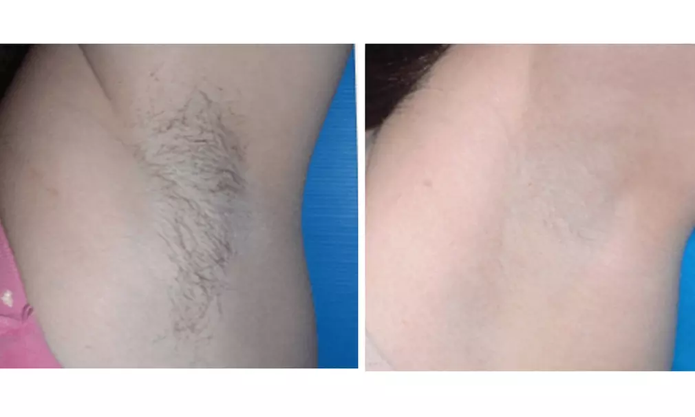 6 Sessions of Laser Hair Removal in Small, Medium, Large Areas & More