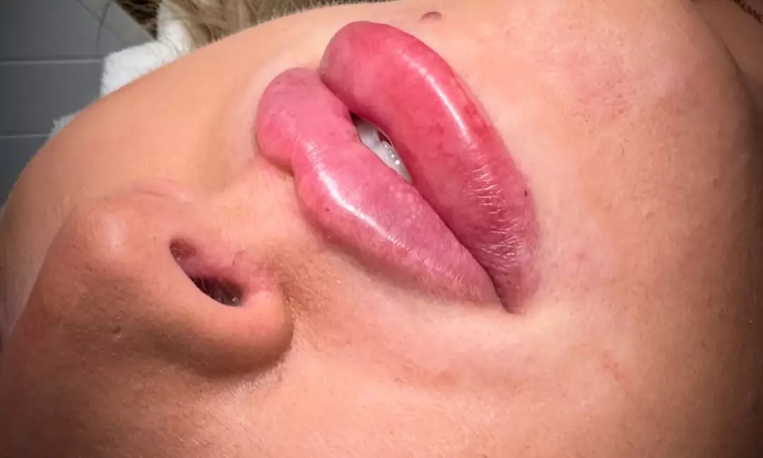 Enhance Your Natural Beauty with Dermal Filler Treatments