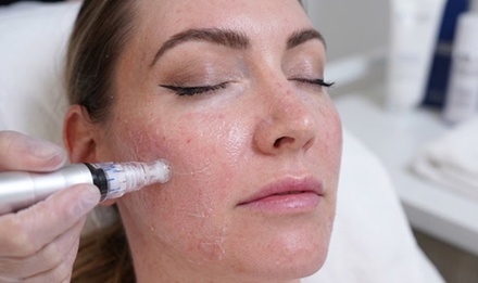 One SkinPen® Microneedling Treatment with Salmon DNA (PDRN) + Collagen & PDRN Face Mask - Sanctuary DermaSpa