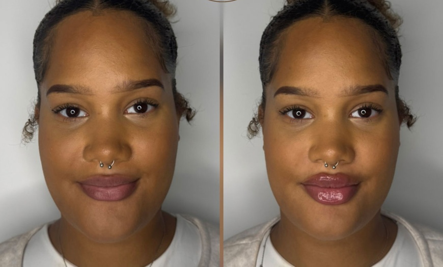 Image 3: Revitalize with 0.5 or 1 ml of Revolax Dermal Filler with Consultation