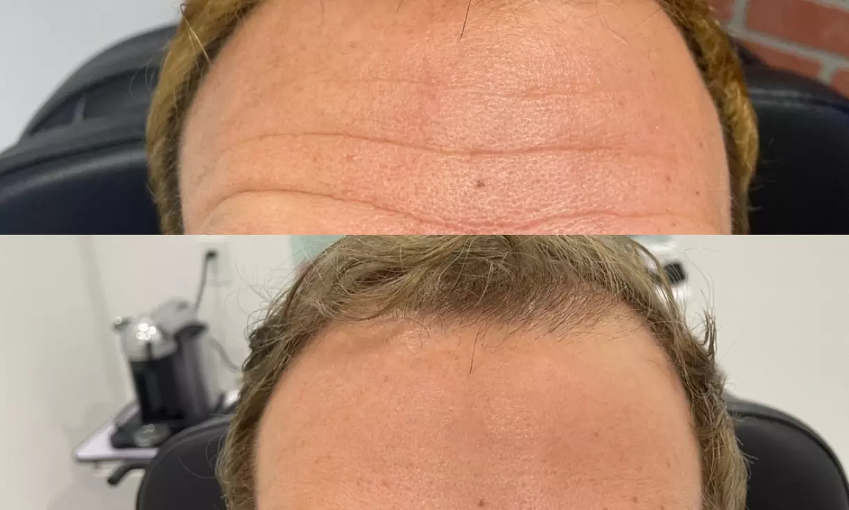 Revitalize with 20, 40, or 60 units Units of Jeuveau