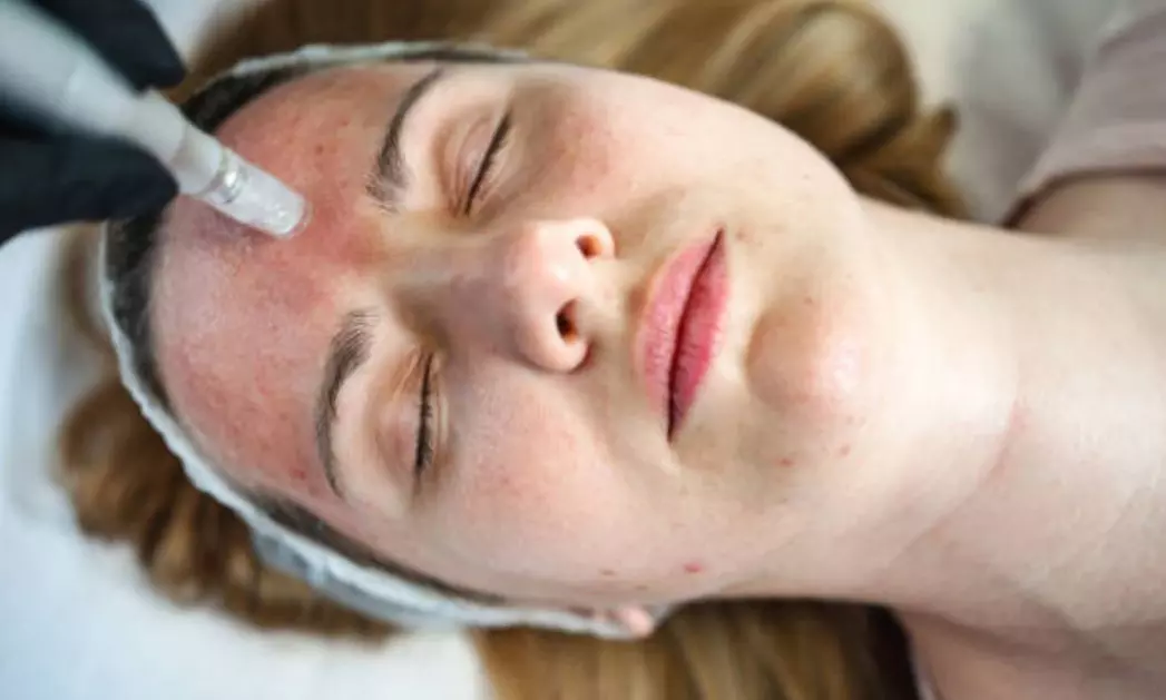 Sesiones de rehidratación de labios o microlifting facial con Dermapen