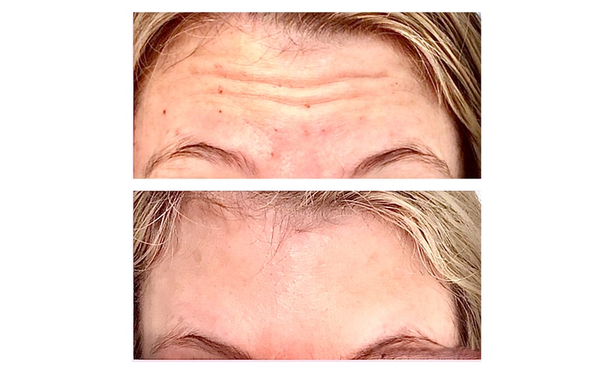 Image 4: Revitalize with 20 or 40 Units of Botox Or One Flip Lip