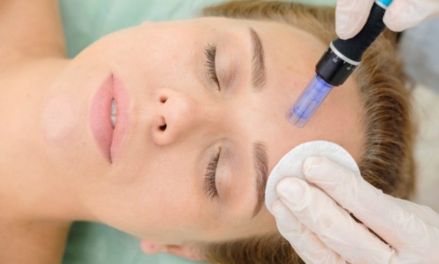 Image 9: Hasta 3 sesiones de microlifting facial de vitaminas con Dermapen