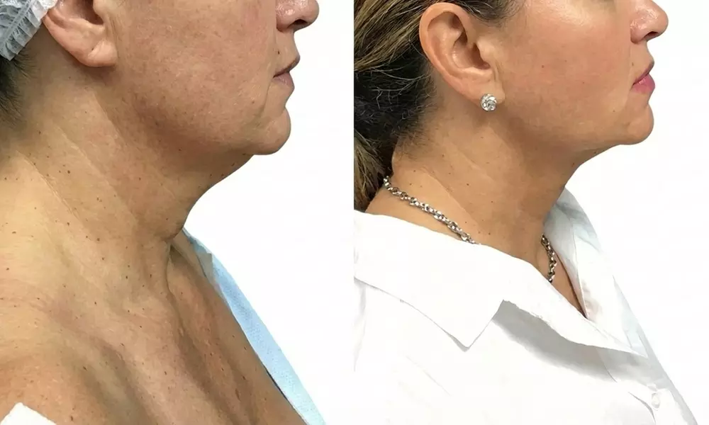 Precision TX Lower Face and Neck Tightening Treatment