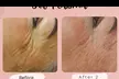 (Up to 70% Off) Transform your skin with One or Two 60-Minute Jet Plasma Treatments at Doll Haus Aesthetics - Second Medium