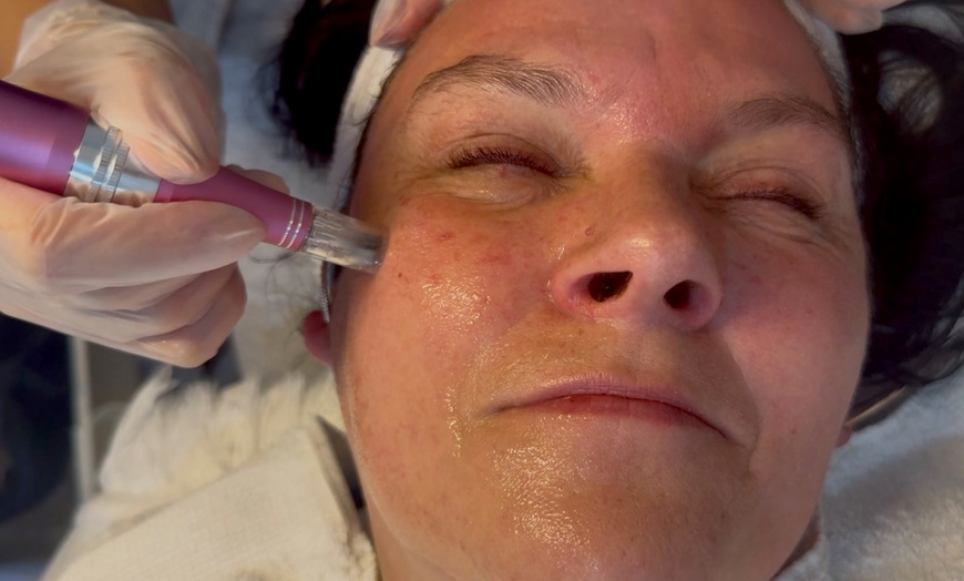 Image 3: 45 Min. Mikrodermabrasion / 60 Min. Mikrodermabrasion & Microneedling