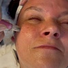 Image 3: 45 Min. Mikrodermabrasion / 60 Min. Mikrodermabrasion & Microneedling