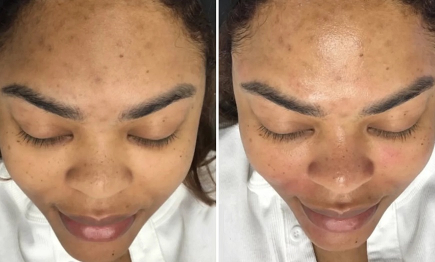 Image 6: Reveal Glowing Skin with One or Two VI Peel