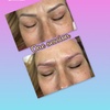 Image 4: Eyebrow Tattoo Removal: Save Up to 30% Off at MB Advanced Beauty MED!