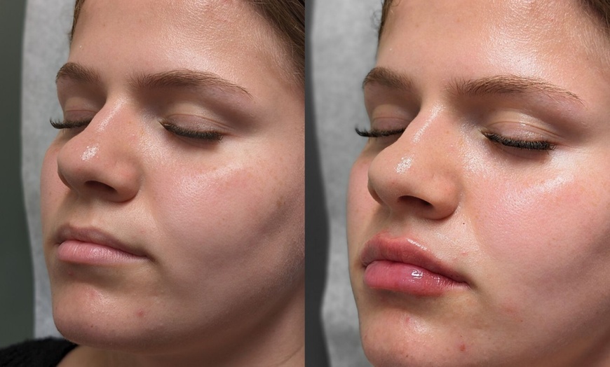 Image 2: Enhance with 20, 40 Units of Botox or Lip Flip (Up to 10 Units)