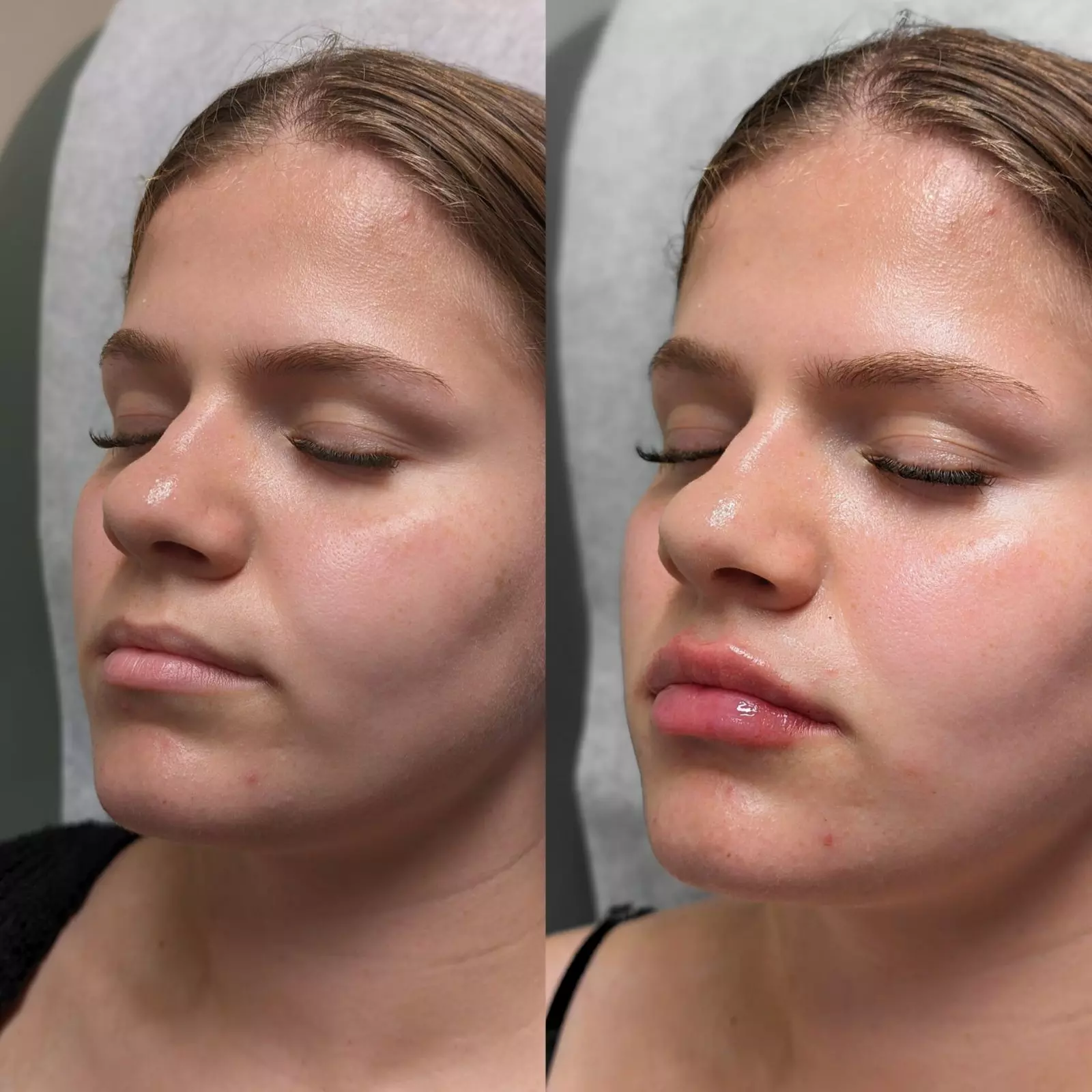 Enhance with 20, 40 Units of Botox or Lip Flip (Up to 10 Units)