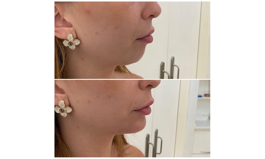 Image 4: ¡Infiltración de relleno dérmico con opción a blanqueamiento dental!